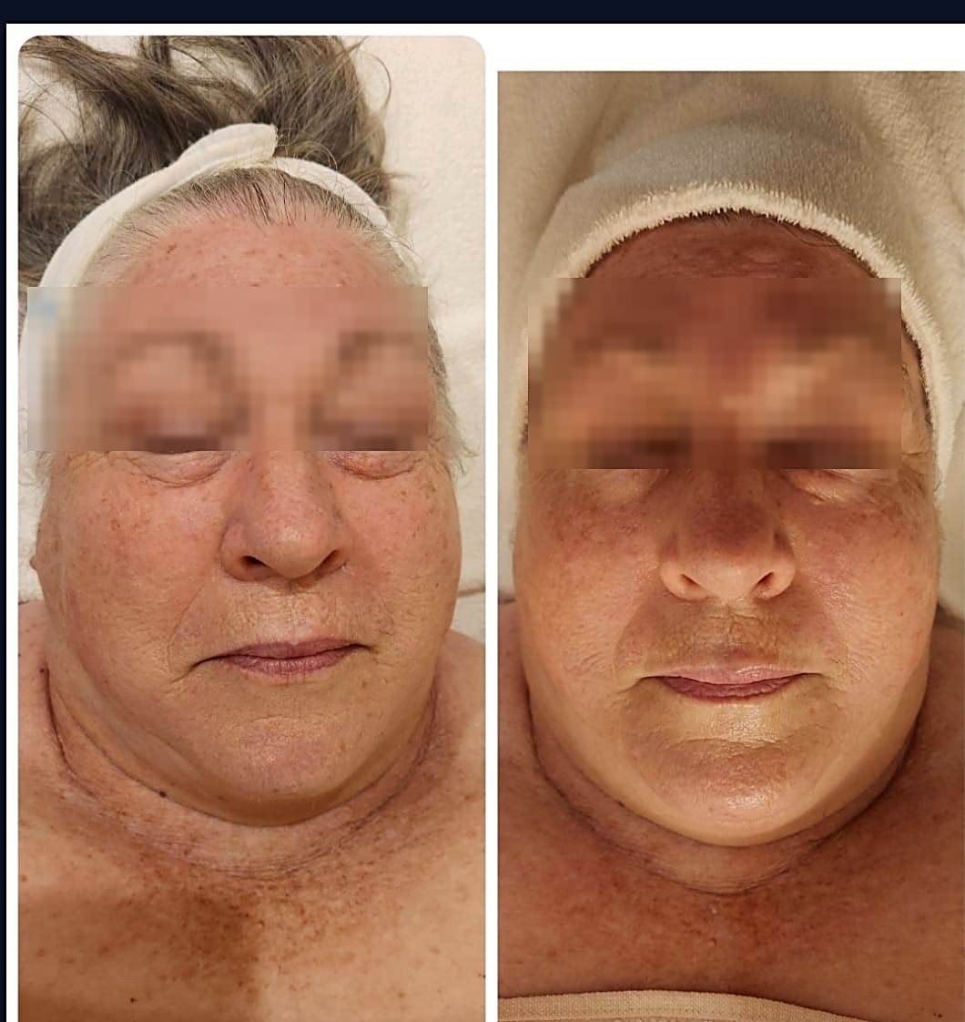 Before and after facial treatment results at Love Thy Skin